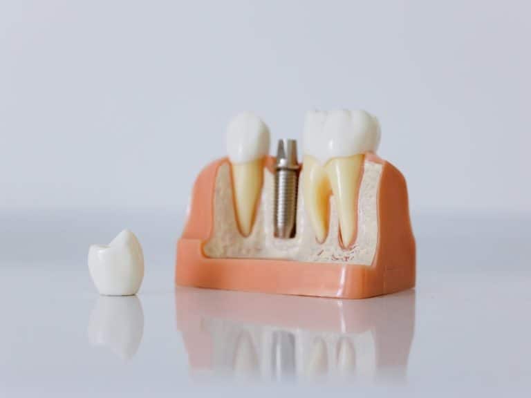 Jenis-jenis Gigi Palsu yang Perlu Anda Ketahui