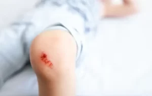 Tahapan Perawatan Luka Laserasi